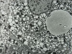 M,7y. | Wilson disease susp. M,7y. | Wilson disease susp.